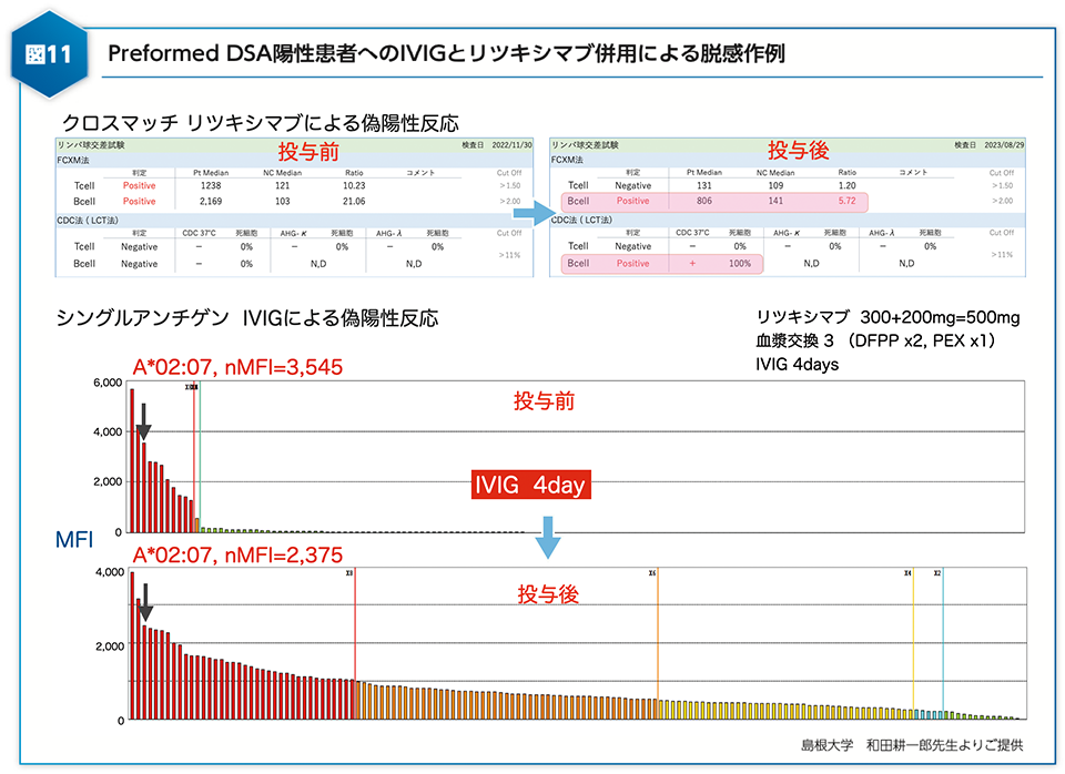 図11 Preformed DSA陽性患者へのIVIGとリツキシマブ併用による脱感作例