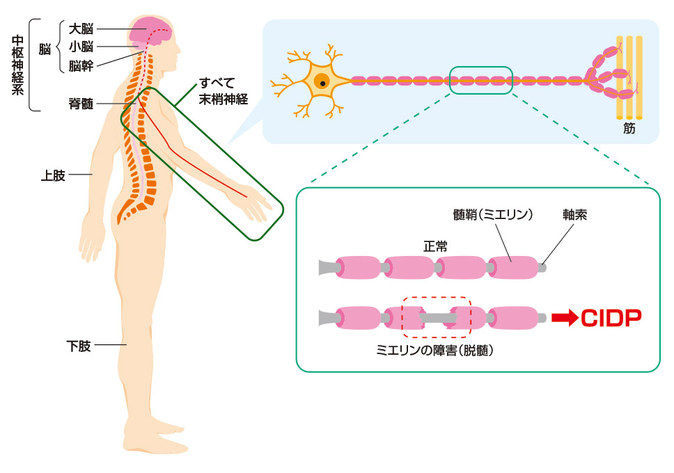 CIDPが主に末梢神経のミエリンが障害（脱髄）される病気のイメージ図