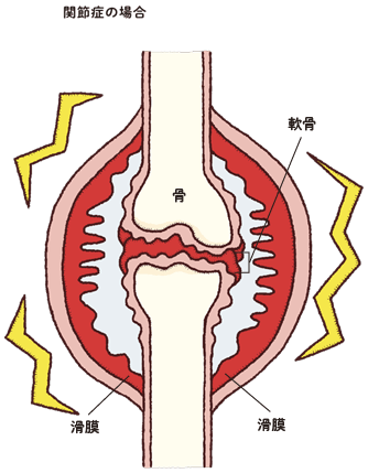 関節症の場合
