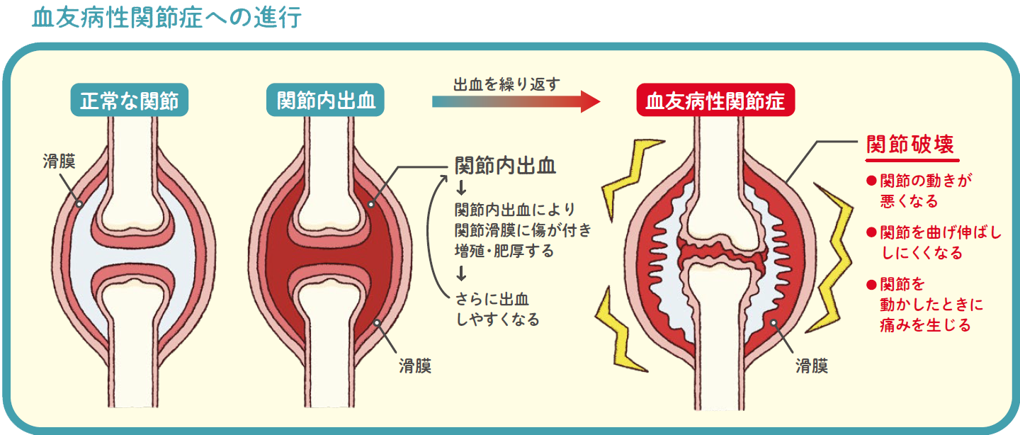 血友病性関節症への進行