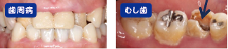 歯周病とむし歯