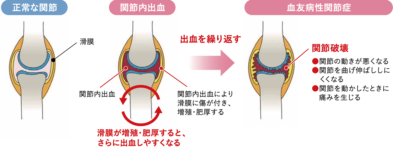 膝の神経の圧迫はどのように診断されますか?