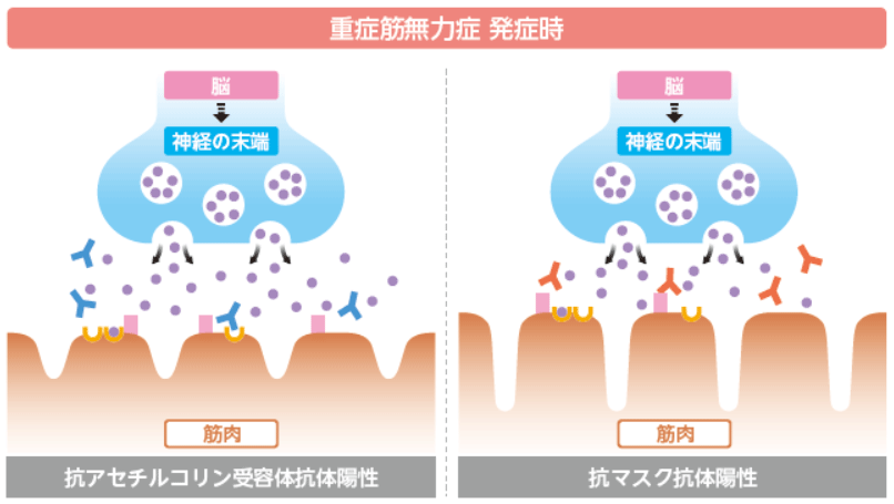 重症筋無力症発症時の挿絵