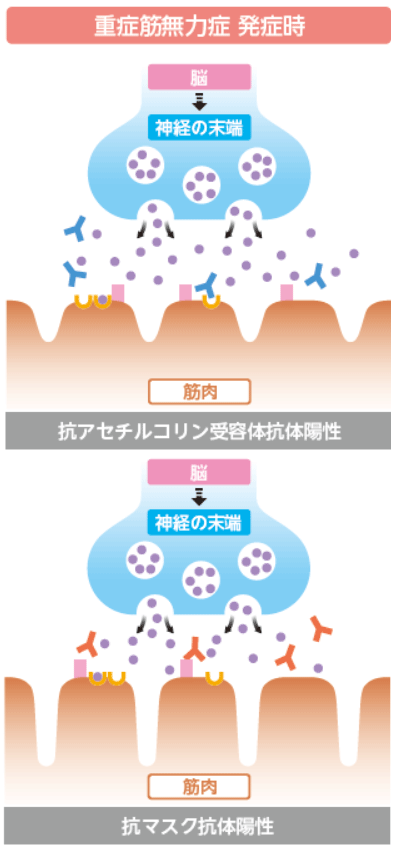 重症筋無力症発症時の挿絵