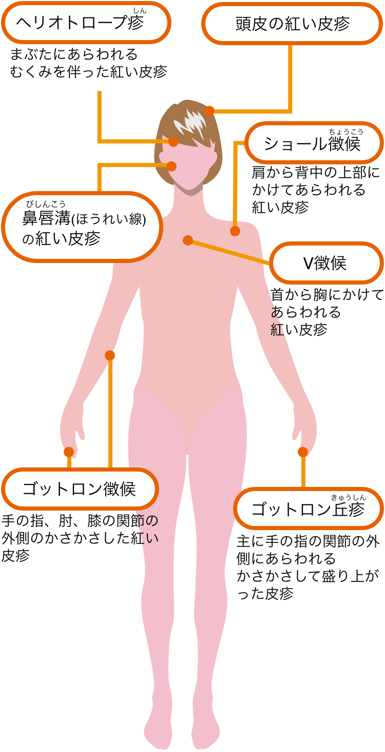 皮膚 筋炎 で 誤っ て いる の は どれ か